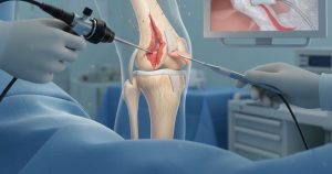 Menisküs Yırtıklarında Kesin Çözüm: Artroskopik Tedavi ile Harekete Geri Dönün